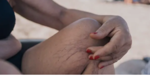 varicose vein treatment options 
